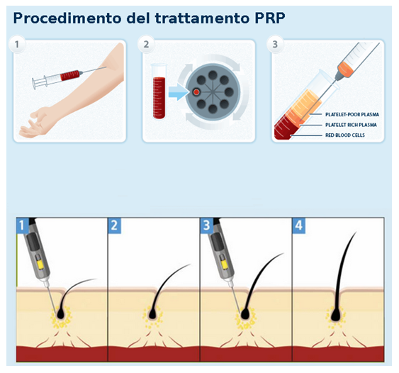 P.R.P. per la Caduta dei Capelli