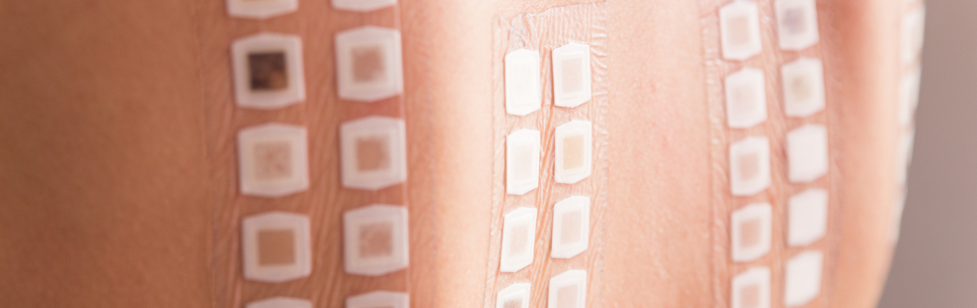 Test Allergologici Epicutanei (Patch Test)